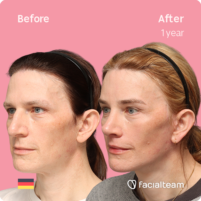 Quadratische Schrägaufnahme des linken Profils der FFS-Patientin Nina S, die die Vorher-Nachher-Ergebnisse mit Facialteam zeigt, einschließlich Stirnfeminisierung, Nasenkorrektur und Adamsapfelreduktion, sowie zervikofaziales Lifting und Lippenfeminisierung als ergänzende Verfahren.