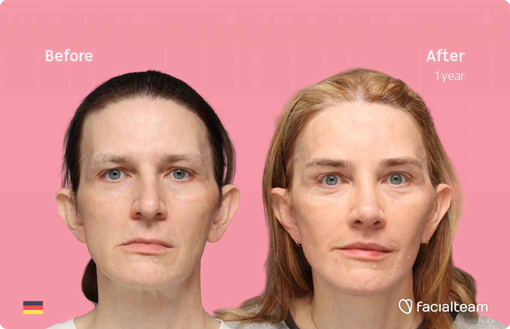 Frontansicht von Nina S, die ihre Vorher-Nachher-Transformation der FFS mit Facialteam zeigt: Stirn, Nasenkorrektur und Adamsapfelreduktion, mit zervikofazialem Lifting und Lippenfeminisierung als ergänzende Eingriffe.