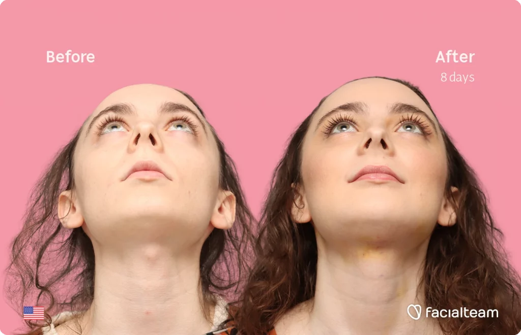 Frontansicht von Alex M aus leicht erhöhter Perspektive, die ihre Vorher-Nachher-Transformation der FFS mit Facialteam zeigt: Stirn, Kinn und Adamsapfelreduktion.