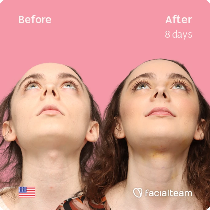 Quadratische Frontansicht von Alex M aus leicht erhöhter Perspektive, die ihre Vorher-Nachher-Transformation der FFS mit Facialteam zeigt: Stirn, Kinn und Adamsapfelreduktion.