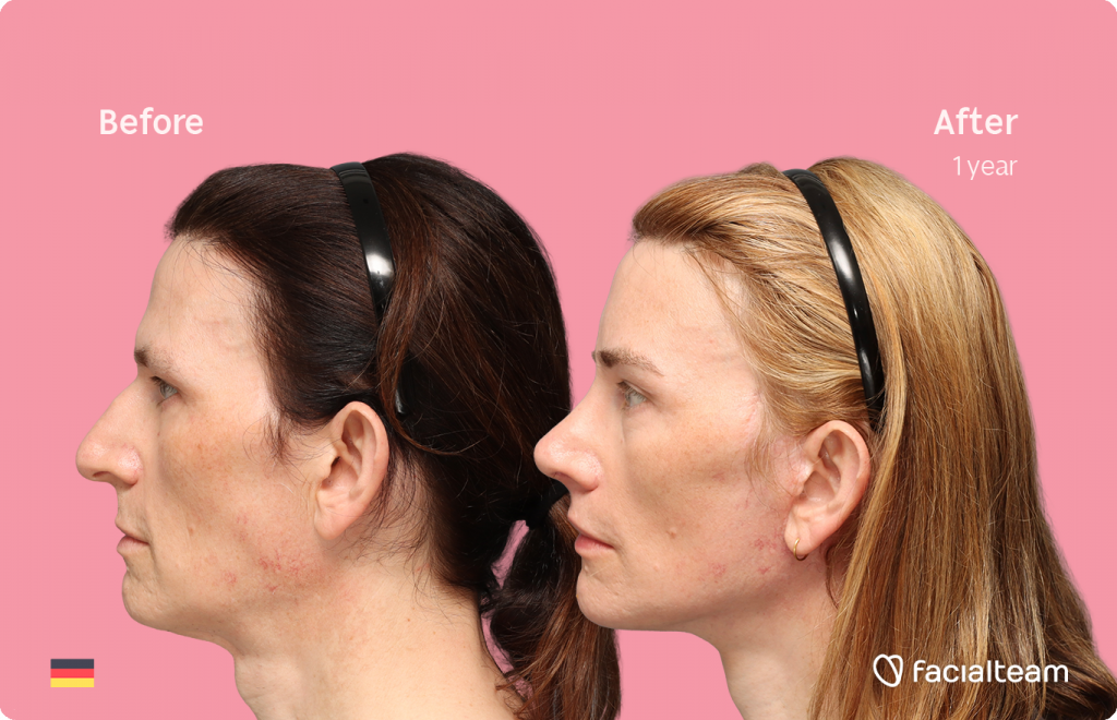 Aufnahme des linken Profils der FFS-Patientin Nina S, die die Vorher-Nachher-Ergebnisse mit Facialteam zeigt, einschließlich Stirnfeminisierung, Nasenkorrektur und Adamsapfelreduktion, sowie zervikofaziales Lifting und Lippenfeminisierung als ergänzende Verfahren.