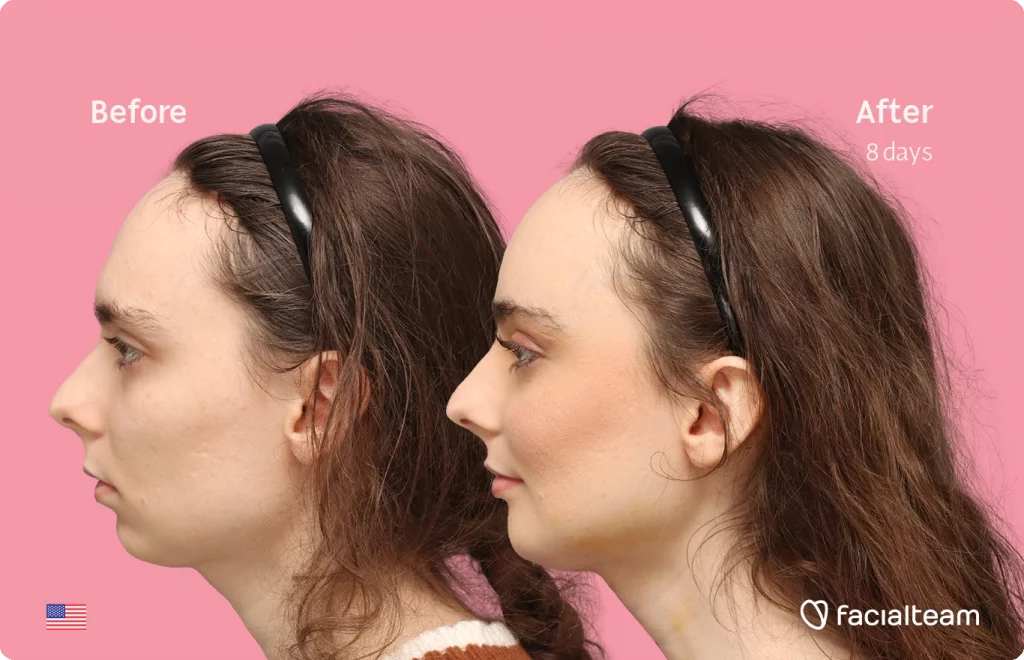 Aufnahme des linken Profils der FFS-Patientin Alex M, die die Vorher-Nachher-Ergebnisse mit Facialteam zeigt, einschließlich Stirnfeminisierung, Kinnfeminisierung und Adamsapfelreduktion.