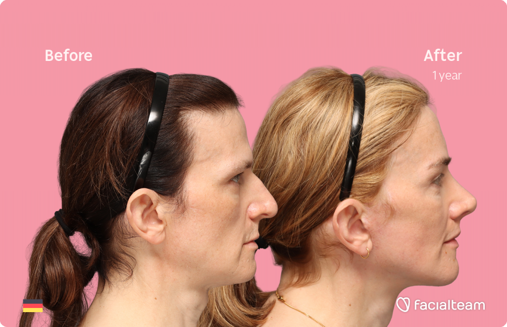 Aufnahme des rechten Profils der FFS-Patientin Nina S, die die Vorher-Nachher-Ergebnisse mit Facialteam zeigt, einschließlich Stirnfeminisierung, Nasenkorrektur und Adamsapfelreduktion, sowie zervikofaziales Lifting und Lippenfeminisierung als ergänzende Verfahren.