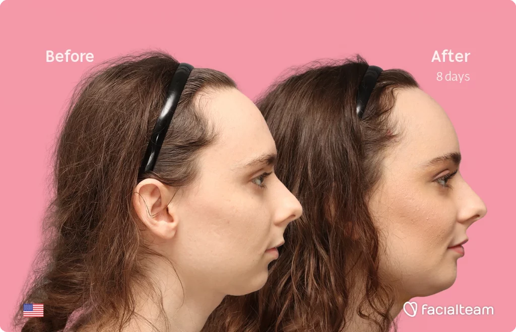 Aufnahme des rechten Profils der FFS-Patientin Alex M, die die Vorher-Nachher-Ergebnisse mit Facialteam zeigt, einschließlich Stirnfeminisierung, Kinnfeminisierung und Adamsapfelreduktion.