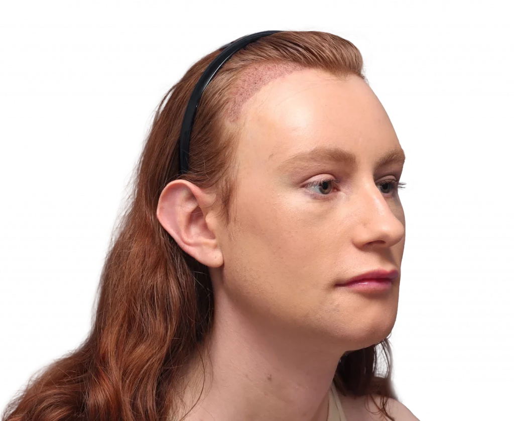 Schrägaufnahme des rechten Profils von Annah nach der Operation.