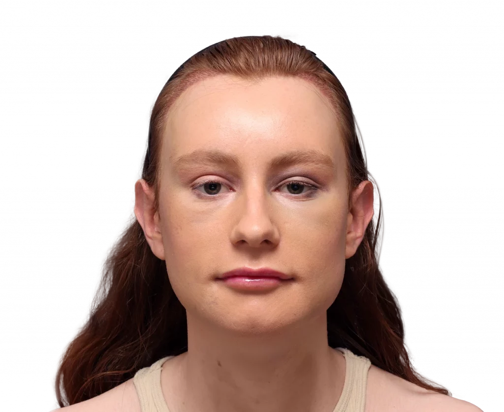 Frontaufnahme von Annah nach der Operation.