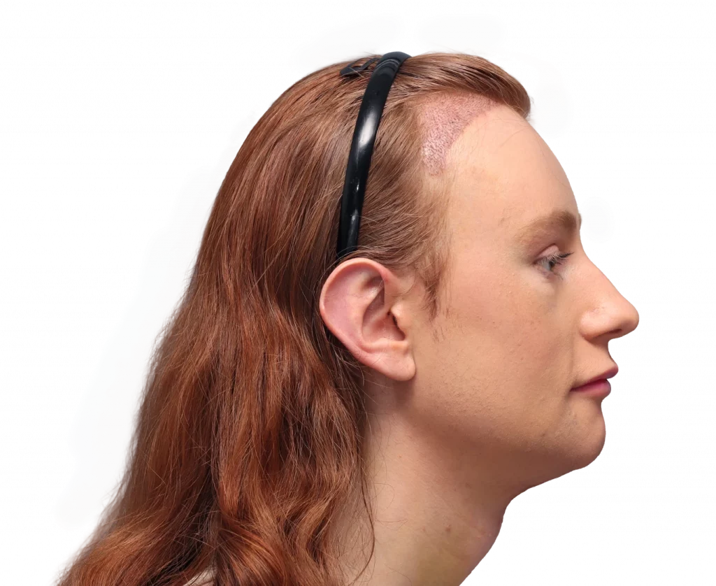 Seitenansicht des rechten Profils von Annah nach der Operation.