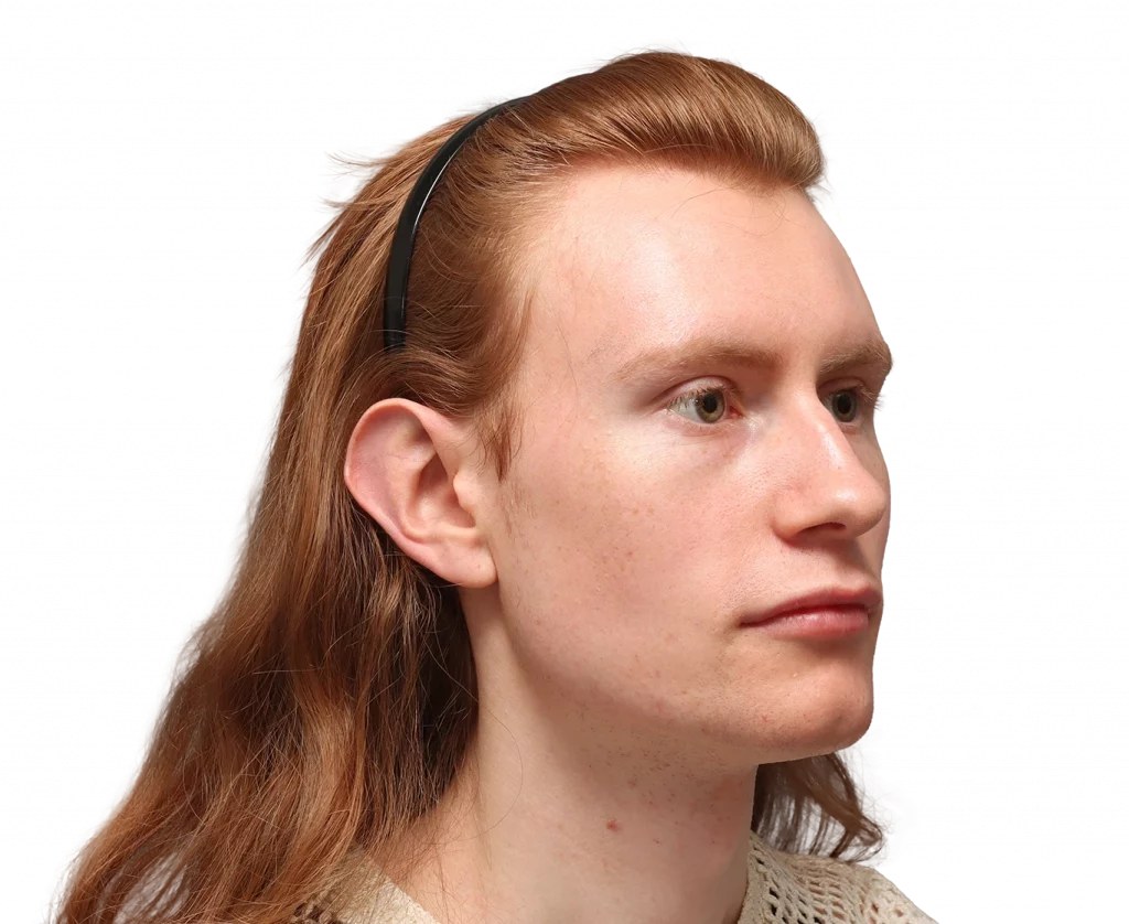 Schrägaufnahme des rechten Profils von Annah von der Operation.