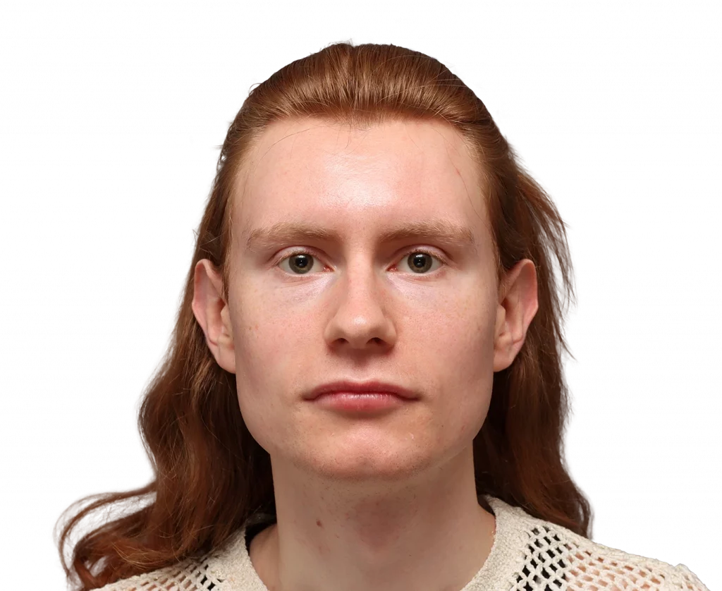 Frontaufnahme von Annah vor der Operation.