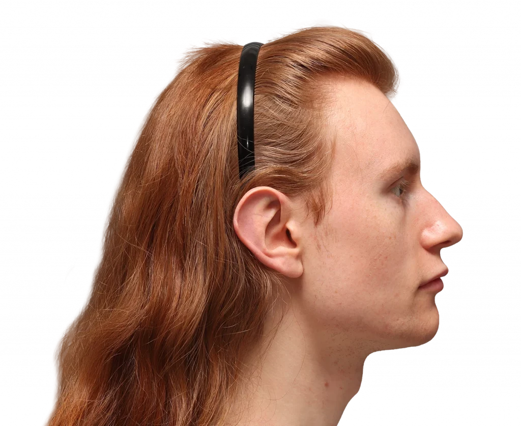 Seitenansicht des rechten Profils von Annah vor der Operation.