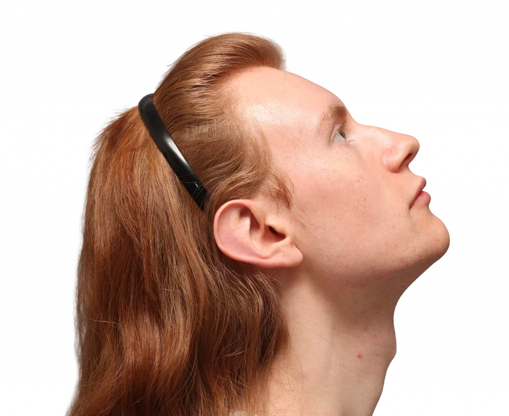 Rechtes Profil von oben von Annah vor der Operation.