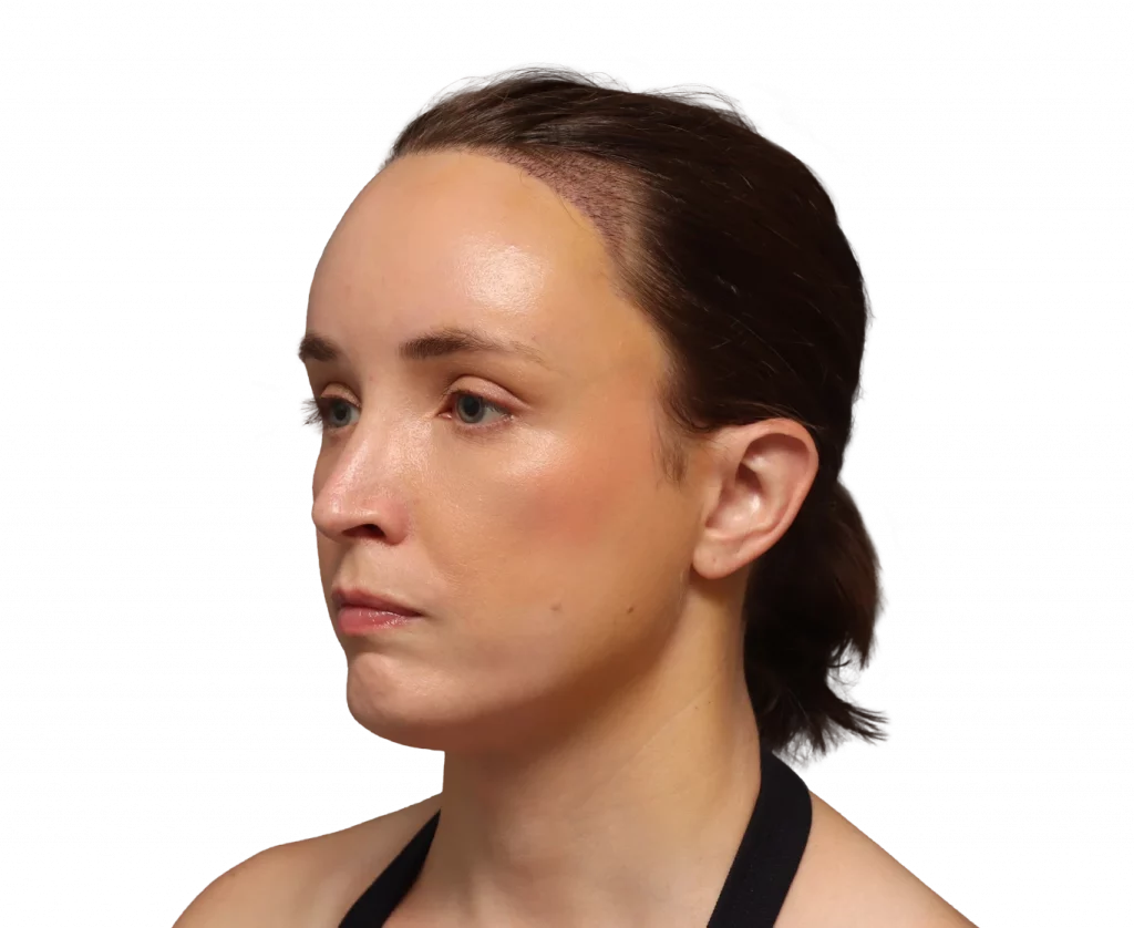 Linkes Profil in Schrägaufnahme von Erin nach der Operation.