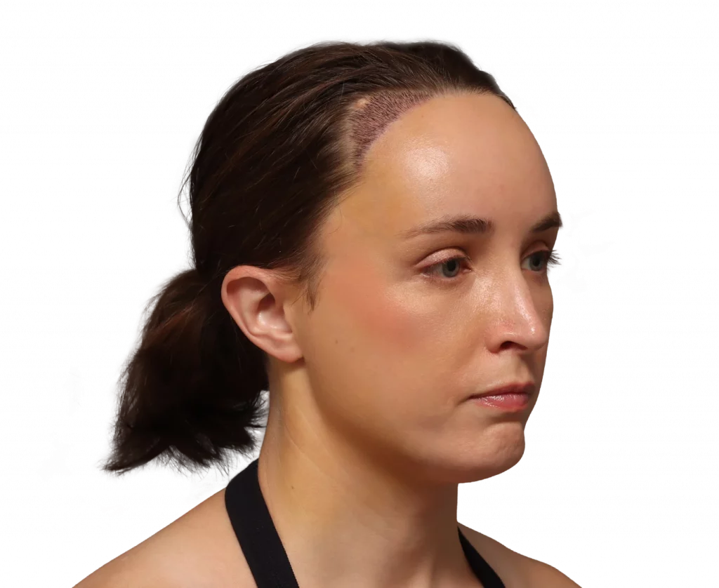 Rechtes Profil in Schrägaufnahme von Erin nach der Operation.