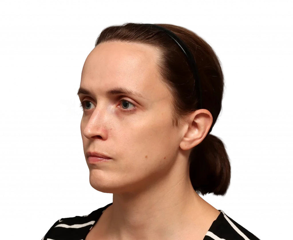 Linkes Profil in Schrägaufnahme von Erin vor der Operation.