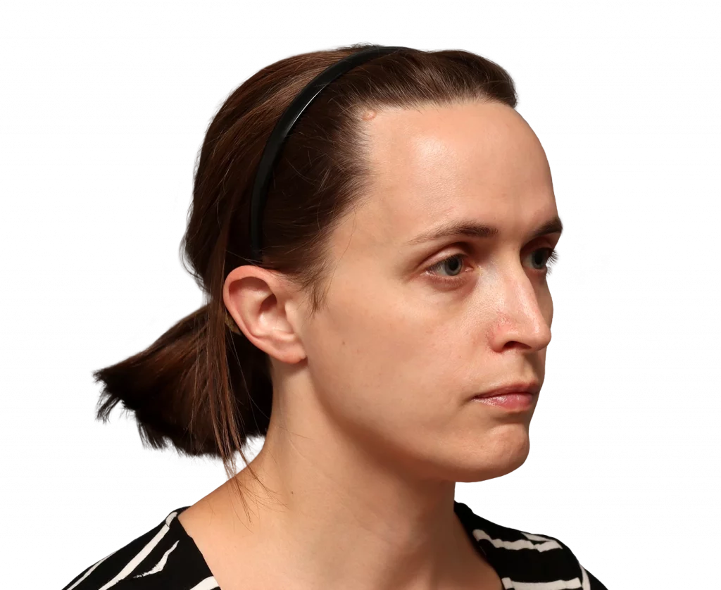 Rechtes Profil in Schrägaufnahme von Erin vor der Operation.