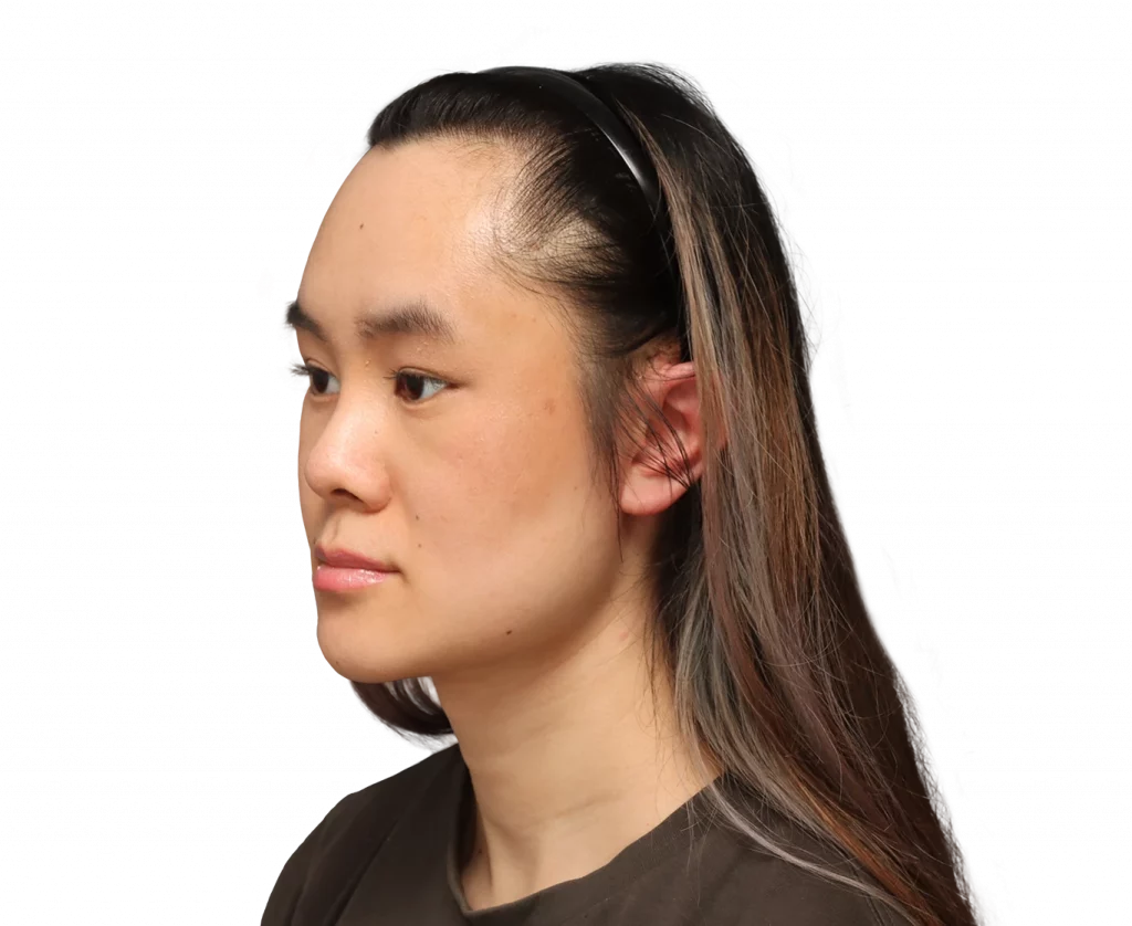 Frontaufnahme im linken Winkel von Val nach der Operation.