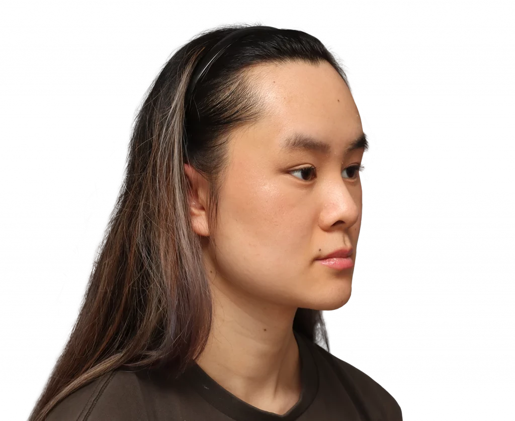 Frontaufnahme im rechten Winkel von Val nach der Operation.