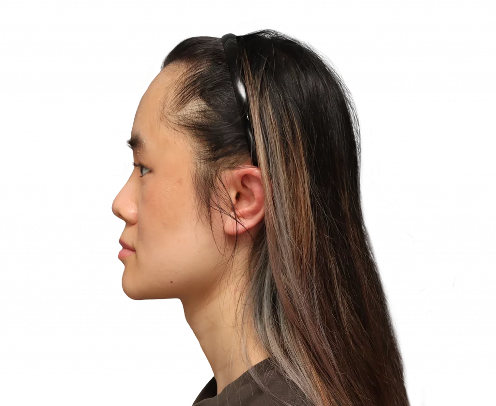 Linkes Profil von Val nach der Operation.