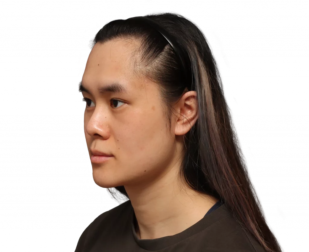 Frontaufnahme im linken Winkel von Val vor der Operation.