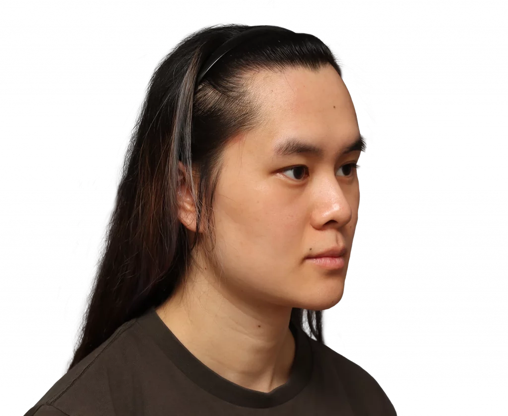 Frontaufnahme im rechten Winkel von Val vor der Operation.