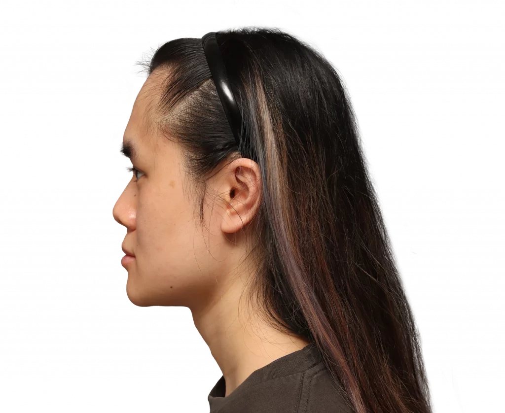 Linkes Profil von Val vor der Operation.