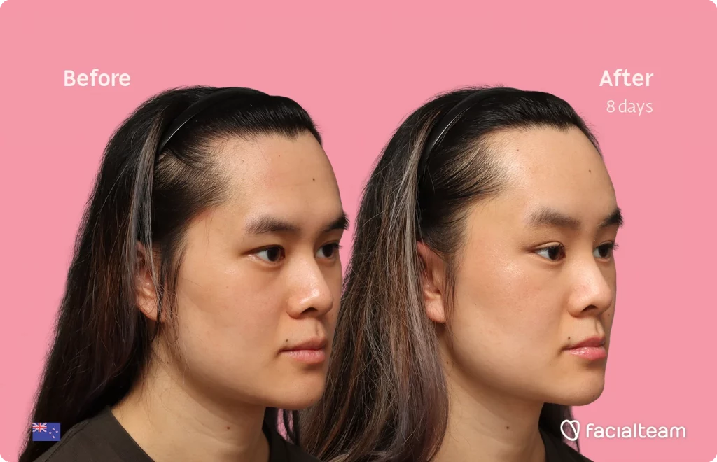 Schrägansicht des rechten Profils der FFS-Patientin Val, die die Vorher-Nachher-Ergebnisse mit Facialteam zeigt, einschließlich Stirnfeminisation.