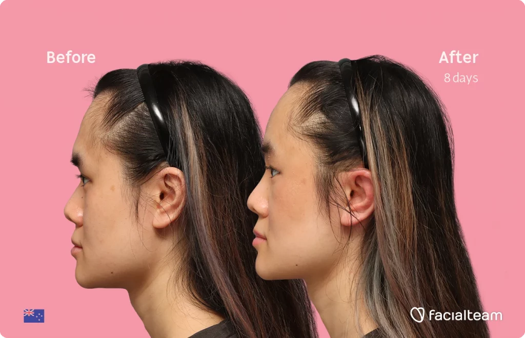 Linkes Profil der FFS-Patientin Val, das die Ergebnisse vor und nach der Behandlung bei Facialteam zeigt, bestehend aus Stirnfeminisation.