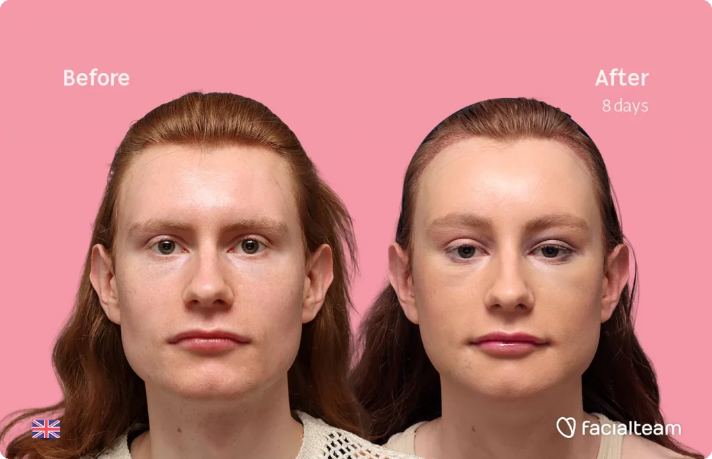 Frontaufnahme der FFS-Patientin Annah, die die Vorher-Nachher-Ergebnisse mit Facialteam zeigt, einschließlich Stirnfeminisierung, Kinnfeminisierung und Adamsapfelreduktion.