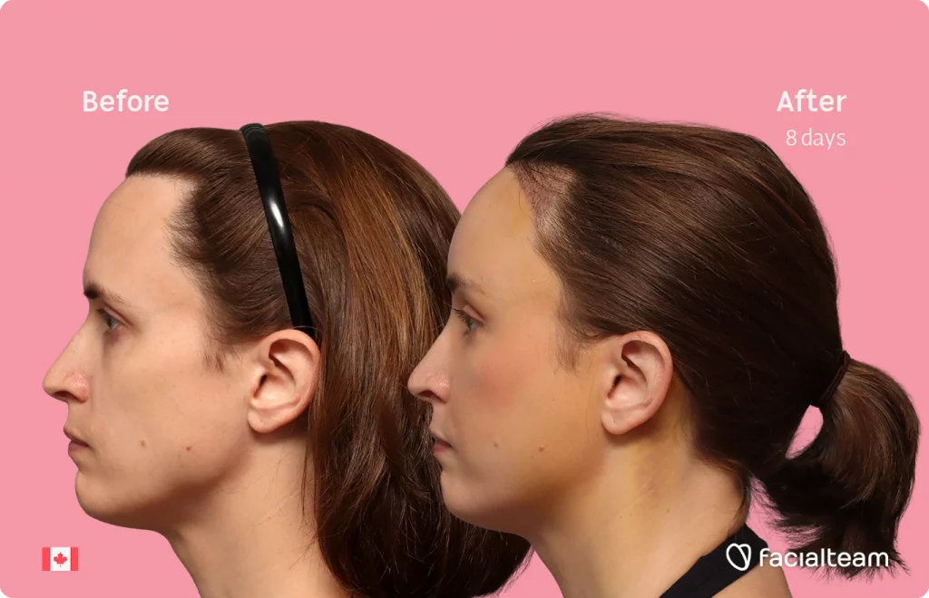 Seitenansicht des linken Profils von Erin mit den Vorher-Nachher-Ergebnissen ihrer FFS bei Facialteam: Stirnfeminisierung mit SHT.