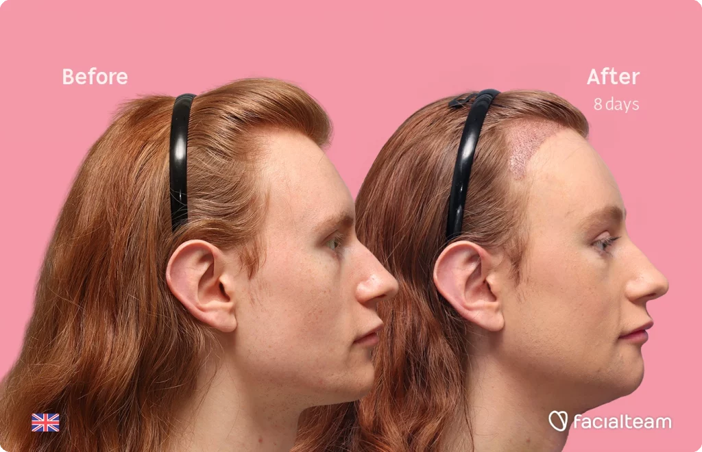 Seitenansicht des rechten Profils der FFS-Patientin Annah, die die Vorher-Nachher-Ergebnisse mit Facialteam zeigt, einschließlich Stirnfeminisierung, Kinnfeminisierung und Adamsapfelreduktion.