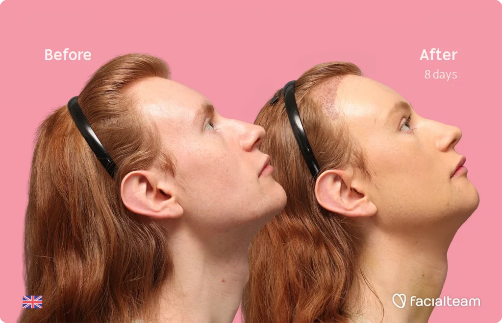 Ansicht des rechten Profils von oben der FFS-Patientin Annah, die die Vorher-Nachher-Ergebnisse mit Facialteam zeigt, einschließlich Stirnfeminisierung, Kinnfeminisierung und Adamsapfelreduktion.