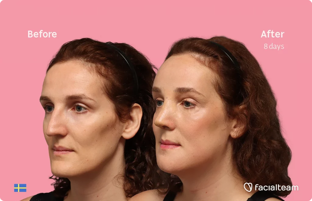 Side-by-side portraits showing before and after a cosmetic treatment after 8 days; pink background, with Swedish flag in corner and Facialteam logo visible