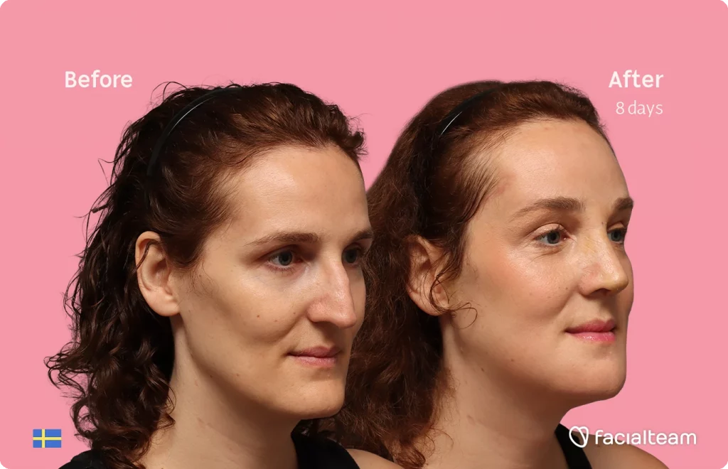 Side-by-side before and after photos showing facial treatment results after 8 days on a pink background; 'Before' on left, 'After 8 days' on right, Facialteam branding visible.