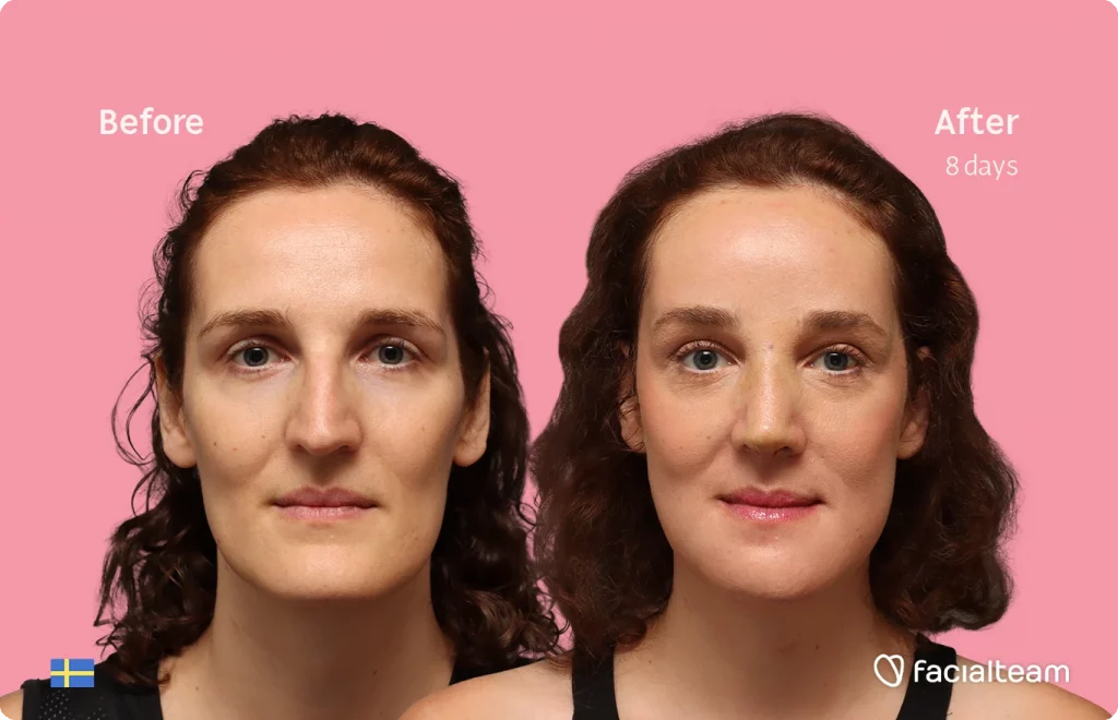 Before and After: a woman’s face shown side by side on a pink background, with 'Before' on the left and 'After 8 days' on the right, as a FacelTeam promo image.