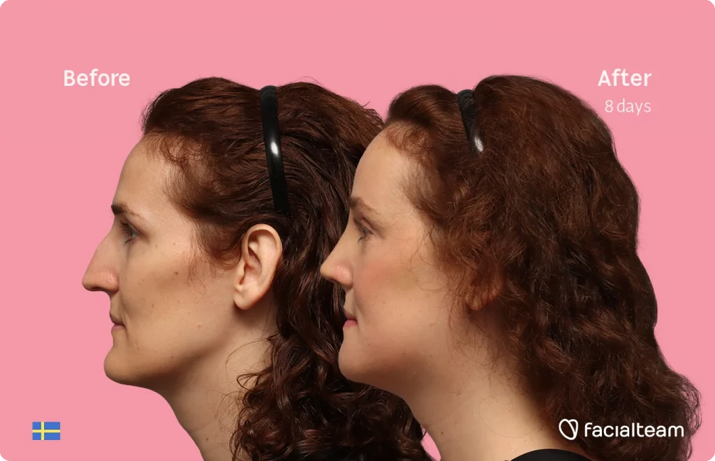 Side-by-side profile comparison of a woman against a pink background: 'Before' on the left and 'After' eight days on the right, with Sweden flag bottom left and Facialteam logo bottom right.