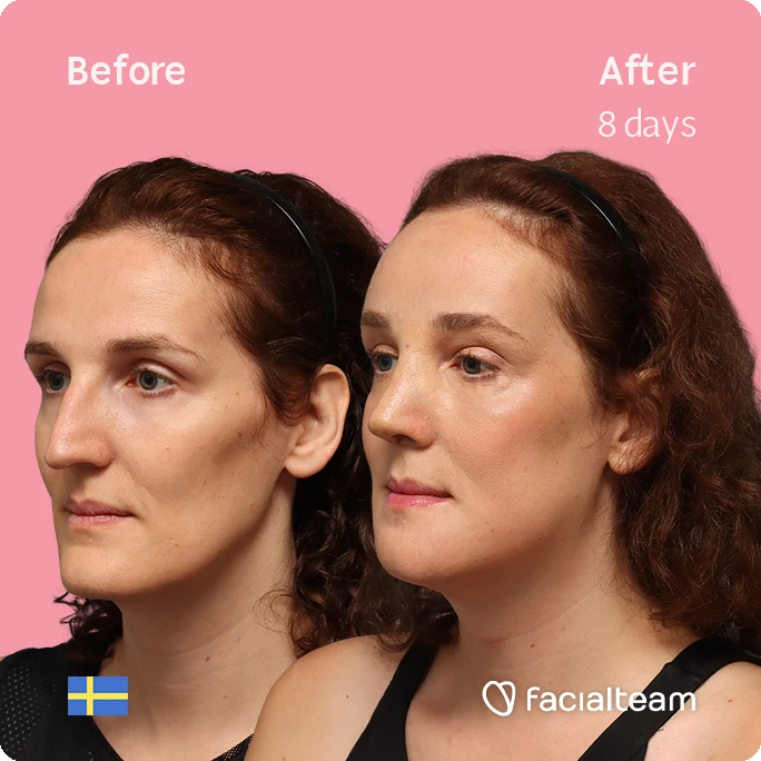 Before and after photos of a woman's face showing improvement after 8 days of treatment; pink background, Swedish flag, and Facetaleam logo.