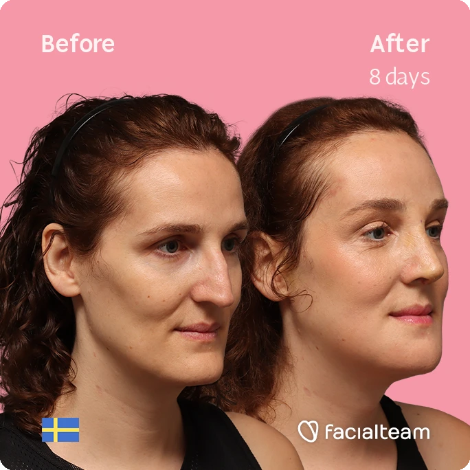 Side-by-side headshots showing a woman's face before and eight days after treatment on a pink background, with a Facialteam logo.