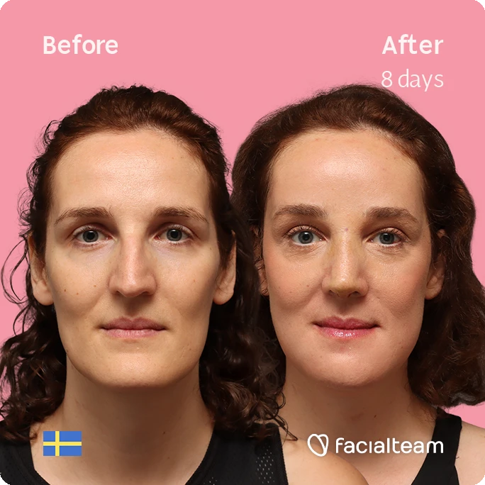 Side-by-side portrait of the same woman on a pink background, left labeled 'Before' and right labeled 'After 8 days', showing improved skin texture after facial treatment.