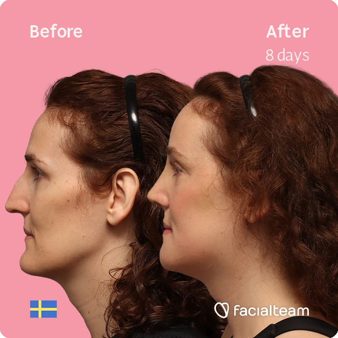 Side-by-side profile of a woman before (left) and eight days after (right) a cosmetic treatment, shown against a pink background with 'Before' and 'After 8 days' labels.