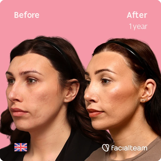 Before-and-after portrait set showing facial improvements after 1 year, pink backdrop, Facialteam watermark.