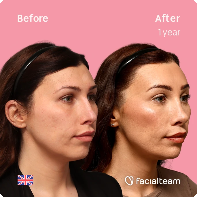 Side-by-side before and after portraits showing facial transformation after 1 year; woman on left with natural look, right with enhanced contour and glow, pink background, FacilaTeam branding.