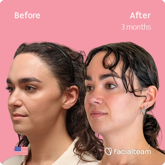 Before-and-after portrait comparison: left shows the face before treatment, right after 3 months, pink background with Facialteam branding.