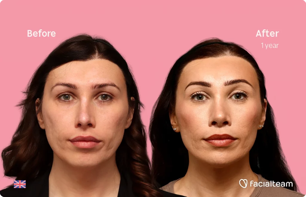 Split view of a woman's face: before (left) and after one year of treatment, showing smoother skin and more defined brows on a pink background.