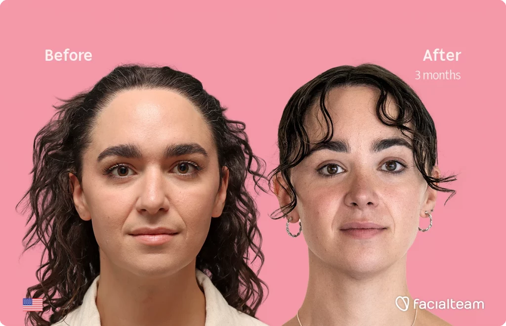 Before and after portrait: left shows a woman before treatment, right shows after 3 months; pink background and FacialTeam logo bottom right.