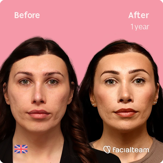 Side-by-side before-and-after photo of a woman after one year of treatment, showing smoother skin, fuller lips, and more defined eyebrows against a pink background (Facialteam).