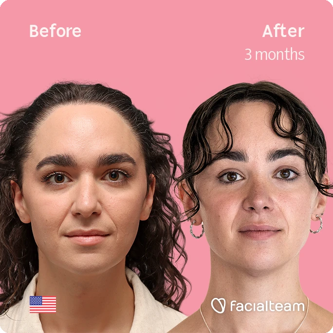 Side-by-side portrait: left is before, right is after three months, pink background, small US flag, Facialteam logo visible.