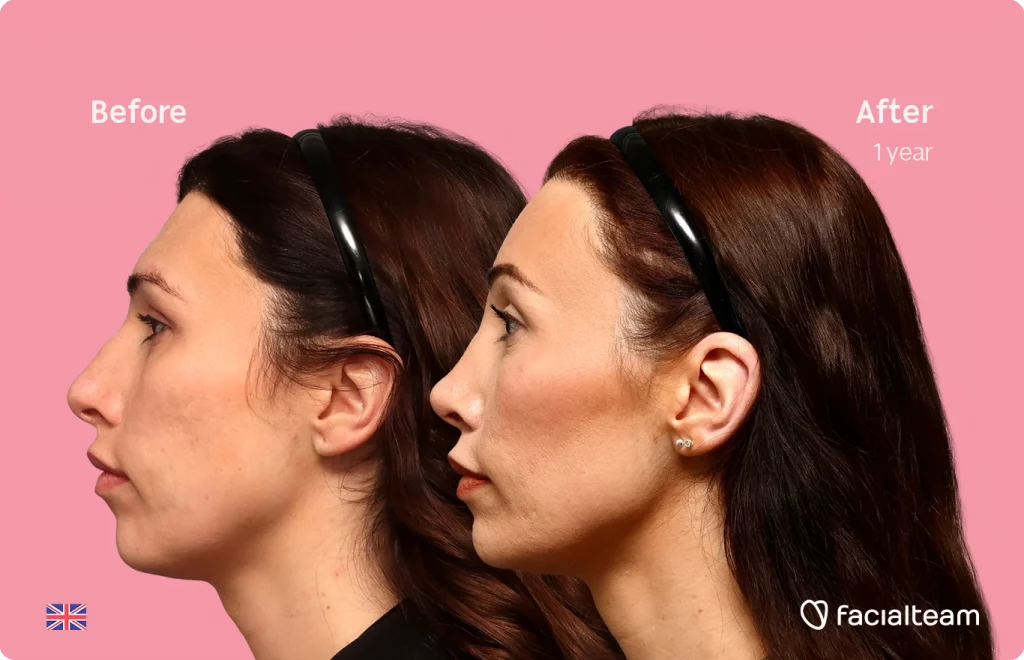Before-and-after side profile of a woman showing facial contour improvement after one year against a pink background, with Facialteam branding.