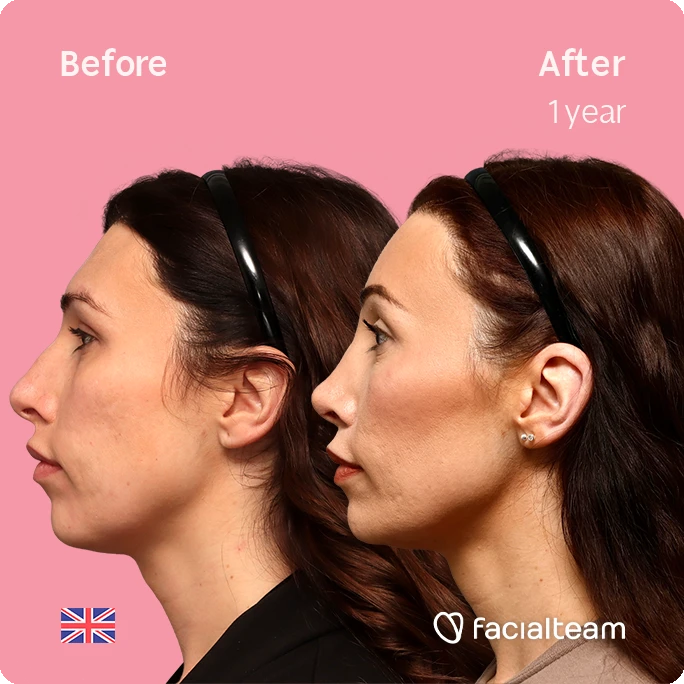 Side-by-side profile of a woman before and after 1 year of treatment, showing a more defined jawline and facial contour on the right, pink background, 'Before' and 'After 1 year' labels.