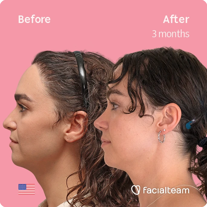 Before and after profile photos on a pink background showing facial improvements after 3 months; left labeled 'Before', right labeled 'After 3 months'.