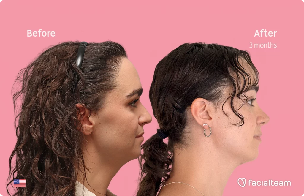 Side-by-side profile photos showing a facial transformation: 'Before' on the left and 'After 3 months' on the right, against a pink background.